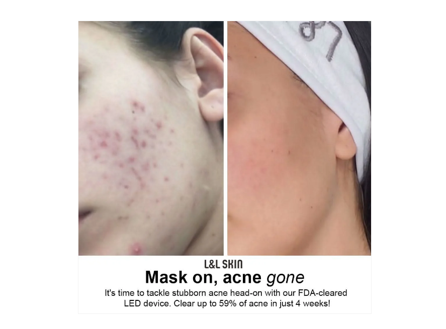 Masque de soin de la peau par luminothérapie LED LUMI