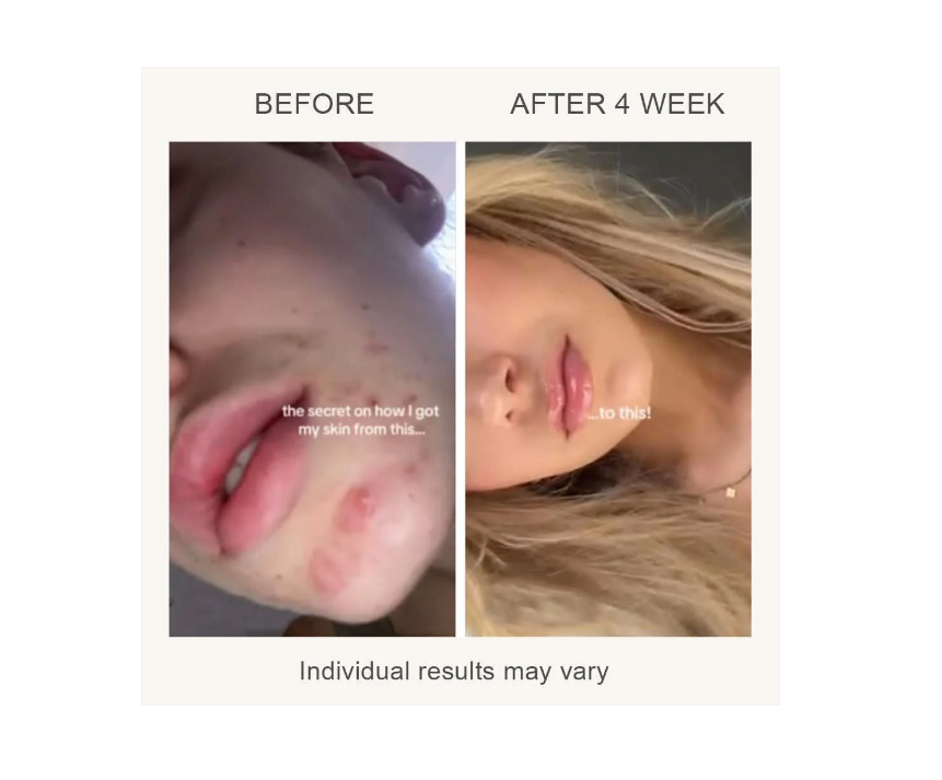 Masque de soin de la peau par luminothérapie LED LUMI